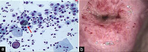 mild inflammation on pap smear|marked acute inflammation on pap.